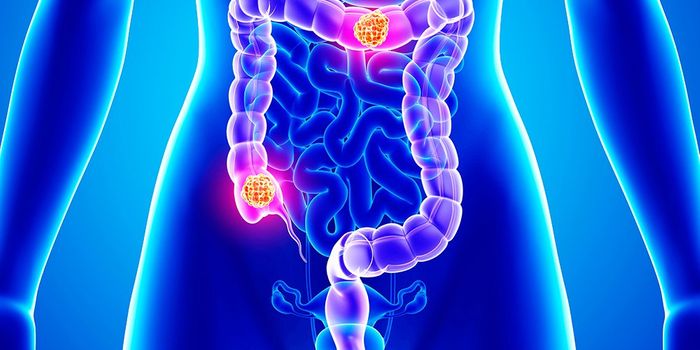 Streptococcus gallolyticus promotes colon cancer