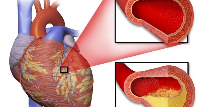 Why You Should Care About Coronary Artery Calcium