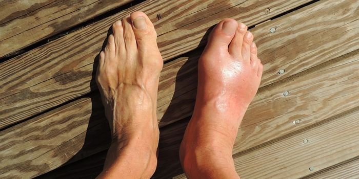 Risk Factors for Gout Revealed by Genome-Wide Association Study