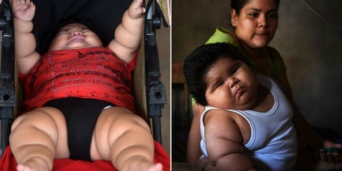 Diagnosed: Prader-Willi Syndrome Behind this Baby's Shocking Size?
