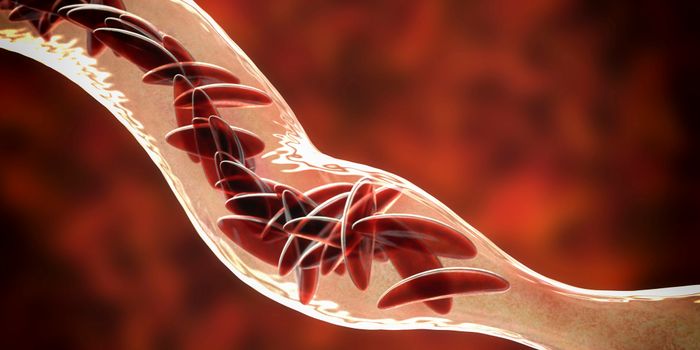 Sickle cell drug promising in clinical trial