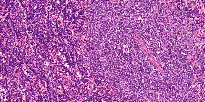 Chance observation:  human leukemia cells turning into harmless immune cells