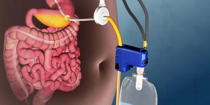 FDA Approves At-Home Stomach Pump for Obesity Treatment