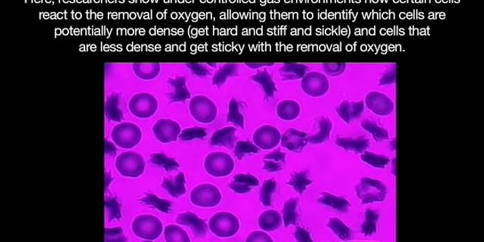 Predicting cell behavior can help Sickle Cell Patients