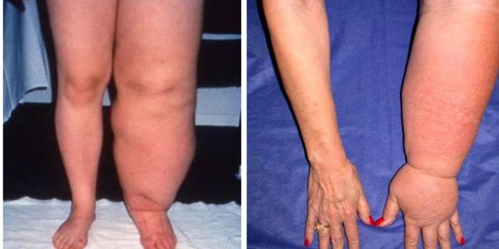 Hope For Patients With Lymphedema