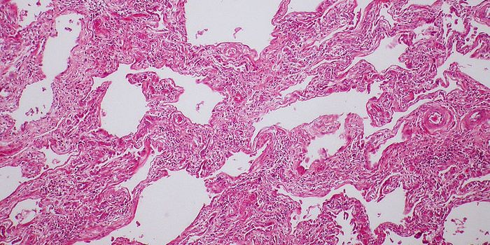 New Scleroderma Treatment: Aggressive Stem Cell Transplant