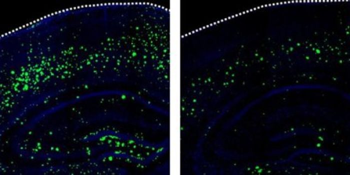 Stroke Drug May Prevent Alzheimer