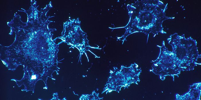 Colorectal Cancers on the Rise in Younger People