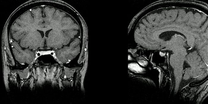 Sex Differences in the Brains of Antisocial Adolescents