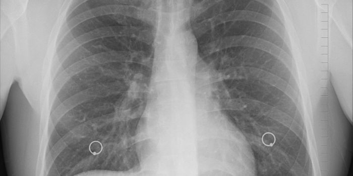 Study Reveals Retained Dust in Lungs of Military Personnel