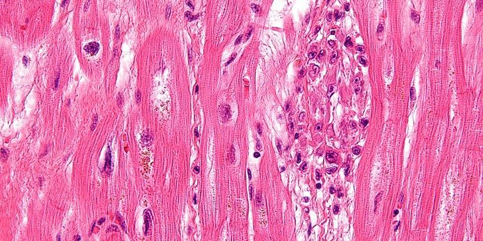 Rheumatic Heart Disease in 1990: Then and Now