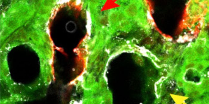 Scientists Reveal how Pancreatic Cancer Evades Chemotherapy