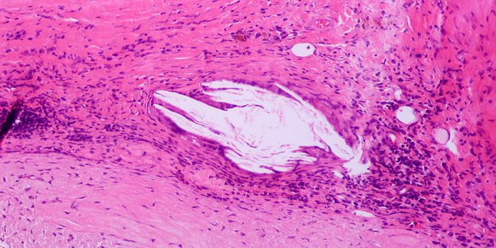 Two Immune Cell Types Accidentally Promote Heart Disease