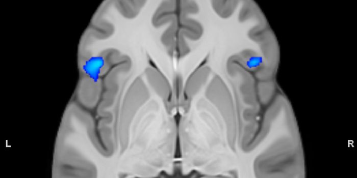 Two Factors That Cause Bipolar Disorder Intertwine