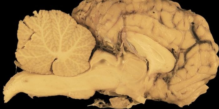 Brain Donation and Why It's Important