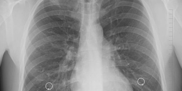 Lung Cancer is Different in Non-Smokers