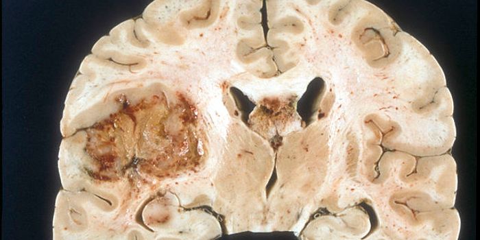 Electrical Stimulation Cap Could Help Brain Cancer Patients