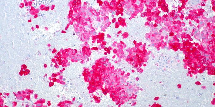 Predicting Melanoma Patients' Responses to Immunotherapy