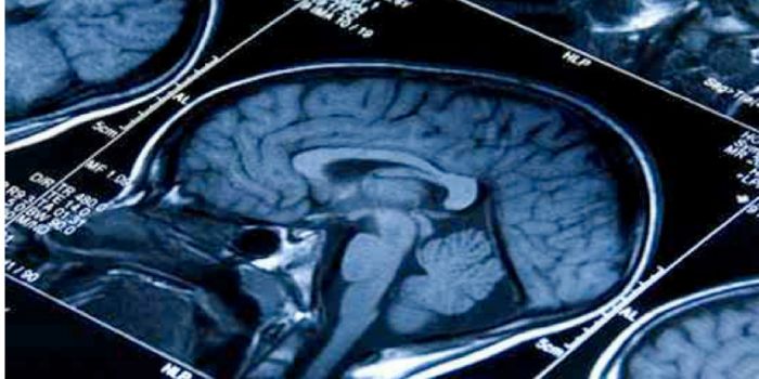 New Molecule Halts Growth of Fatal Pediatric Brain Tumor