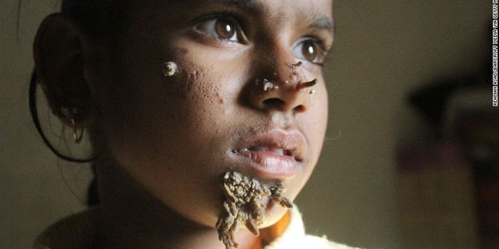 Diagnosed: First Female Case of 'Tree Man Syndrome'