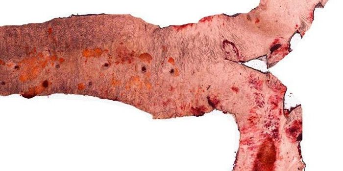 Liver Inflammation Promotes Vascular Disease Via Domino Effect