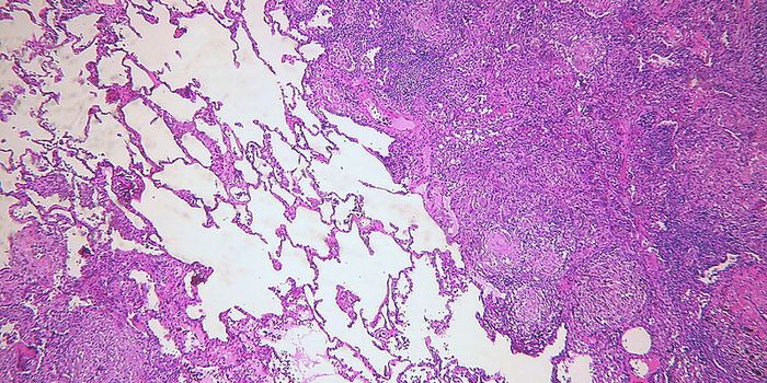 Unique Gene Signature in the Blood Indicates TB Diagnosis