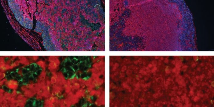 Biologists Identify Brain Tumor Weakness