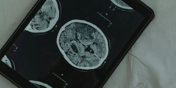 Anxiety Linked to 3 Times Higher Dementia Risk