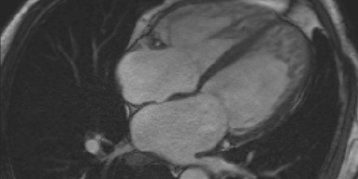 S1P1 Gene Mutation to Blame for Lethal Heart Condition