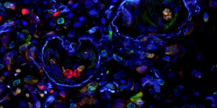 Immune Biomarkers for Idiopathic Pulmonary Fibrosis