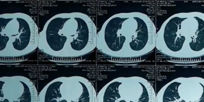 Scientists Found a New Way to Treat Lung Cancer