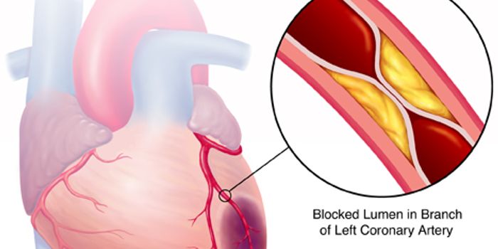 Preventing Heart Failure After Acute Myocardial Infarction