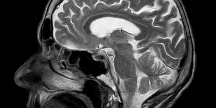 Can Creutzfeldt-Jakob Disease be Diagnosed Before Death?