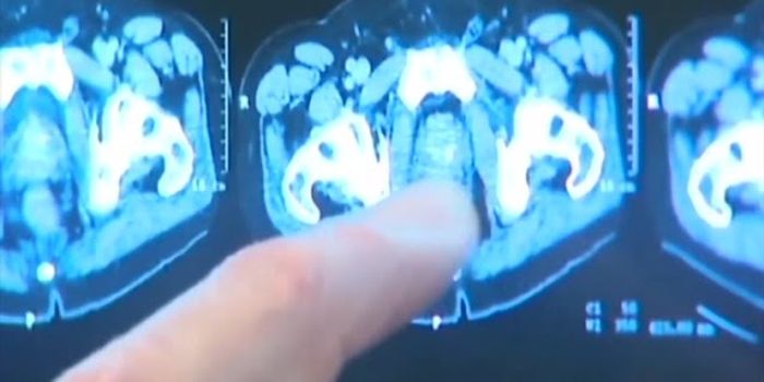 Prostate Therapy and Alzheimer's