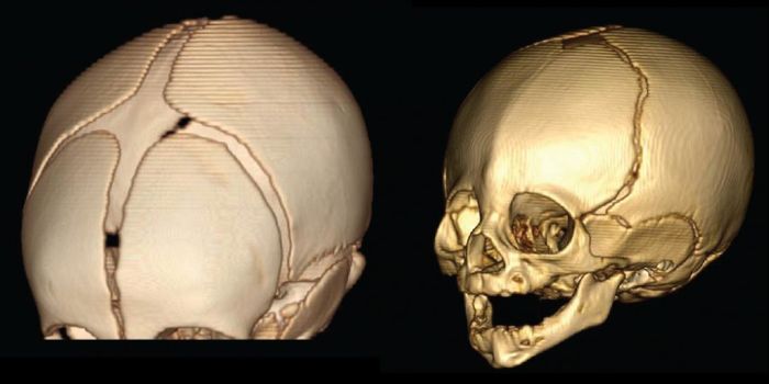 Rare Skull Fusion Disorder Caused By Gene Variant