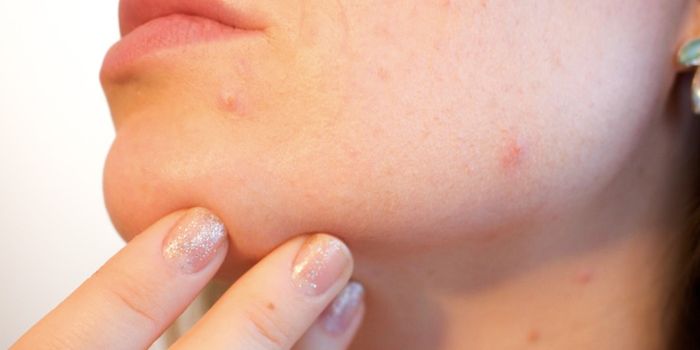 Acne-Causing Skin Microbes are Also Beneficial