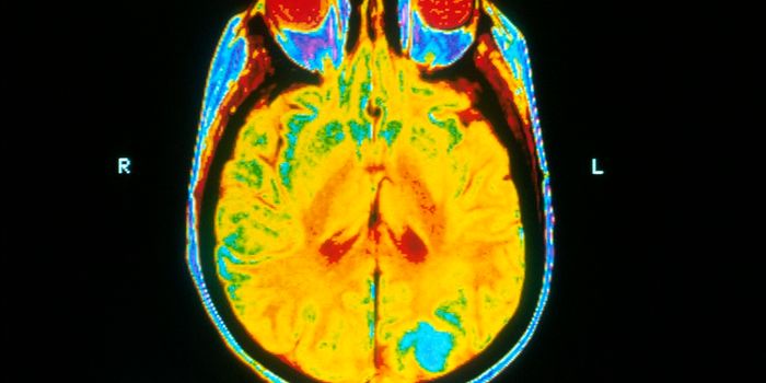 MRI Scans can Help Find HIV in the Brain