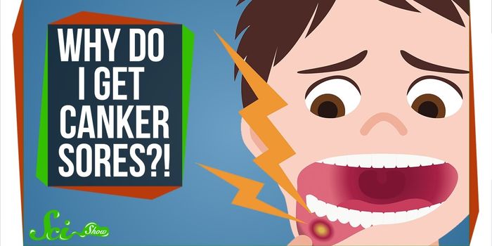 What is a Canker Sore and How to Get Rid of it?
