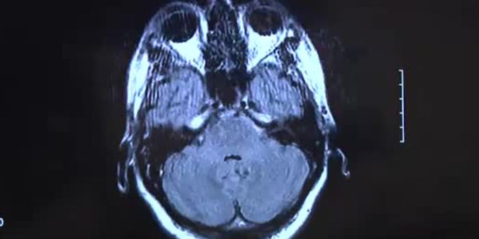 Can Arsenic Be a Treatment for Brain Cancer?