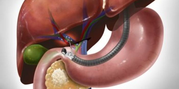 New Test Finds Hidden Pancreatic Cancer Cells, Improves Treatment