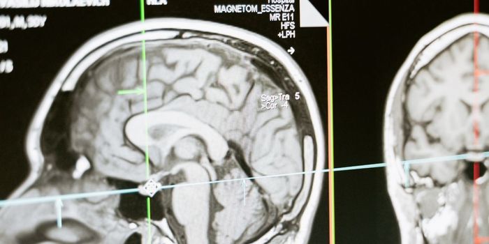 Low Memory Test Scores Linked to Alzheimer's Biomarkers