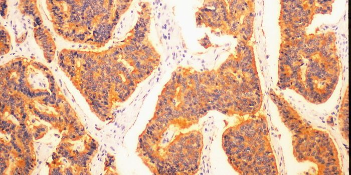 New Biomarker for Lung Cancer Diagnosis