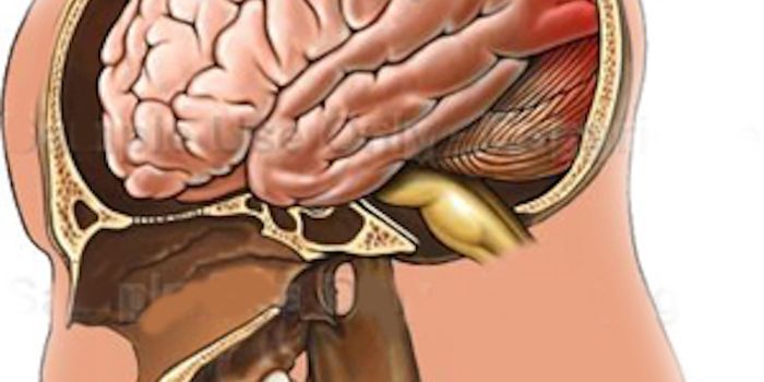 Inflammation at Root of Puzzling Traumatic Brain Injury Symptoms