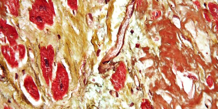 One Gene and Its Role in Heart Disease