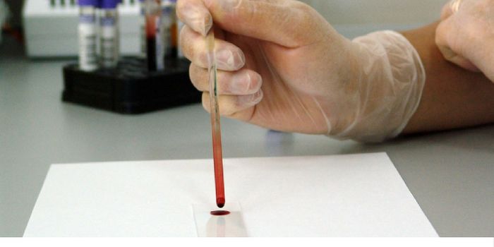 Simple Blood Test Could Improve Colon Cancer Outcomes