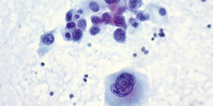 Natural Killer Cells Target Cancer, Shrink Tumors