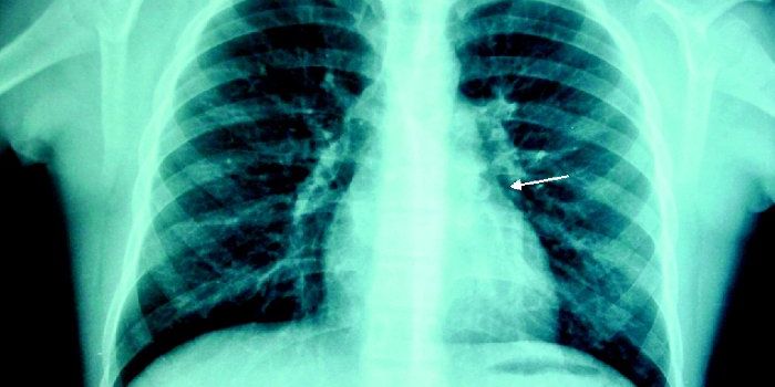 Sedentary Lifestyles Boost Coronary Artery Calcification