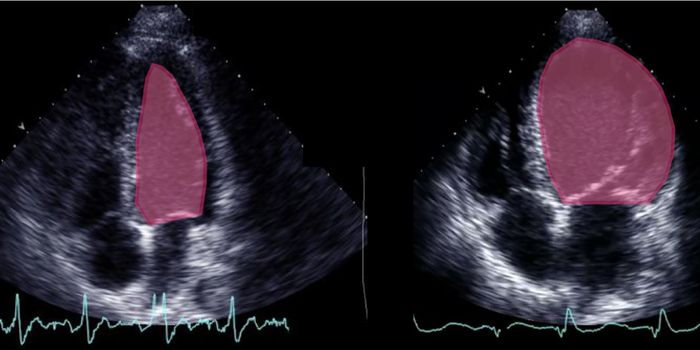 Dilated Cardiomyopathy Has Incriminating Gene Signature