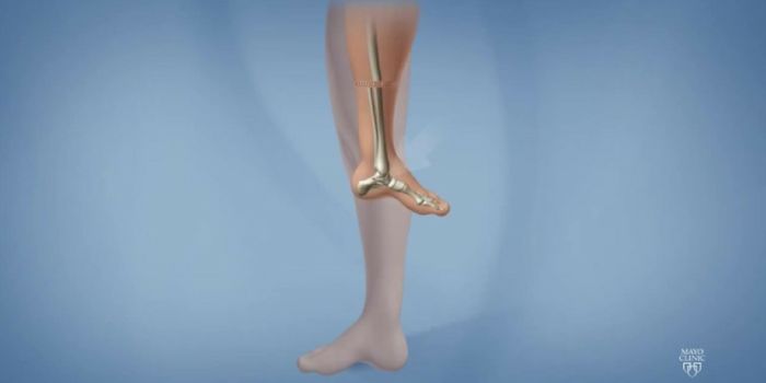 How Rotationplasty Preserves Mobility After Osteosarcoma