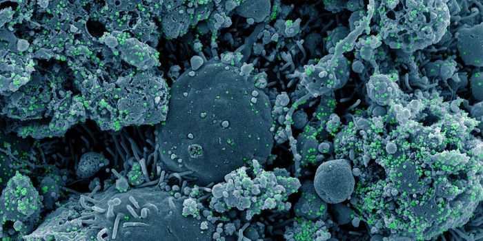 A Genetic Risk Factor is Shared by Alzheimer's and Severe COVID-19